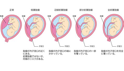 胎盤前置